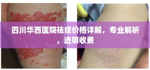 四川華西醫(yī)院祛痣價(jià)格詳解，專業(yè)解析，透明收費(fèi)