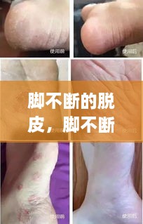 腳不斷的脫皮，腳不斷脫皮還癢 
