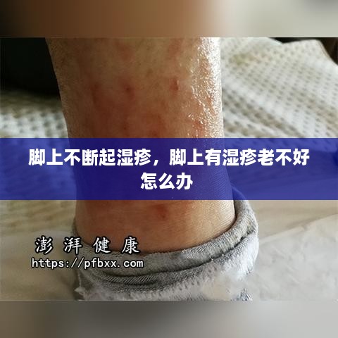 腳上不斷起濕疹，腳上有濕疹老不好怎么辦 