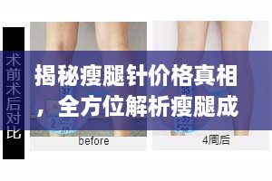 揭秘瘦腿針價(jià)格真相，全方位解析瘦腿成本！