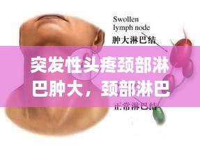 突發(fā)性頭疼頸部淋巴腫大，頸部淋巴結疼頭疼 