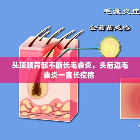 頭頂跟背部不斷長毛囊炎，頭后邊毛囊炎一直長疙瘩 