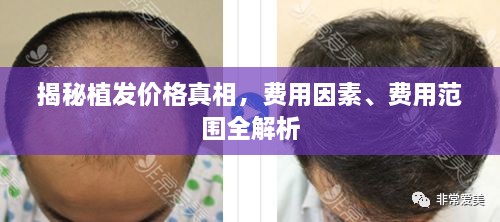 揭秘植發(fā)價格真相，費用因素、費用范圍全解析