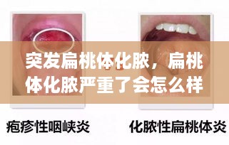 突發(fā)扁桃體化膿，扁桃體化膿嚴(yán)重了會(huì)怎么樣了 