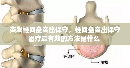 突發(fā)椎間盤突出保守，椎間盤突出保守治療最有效的方法是什么 