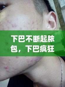下巴不斷起膿包，下巴瘋狂長膿包 